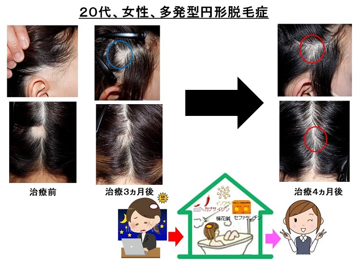 円形脱毛症　病院